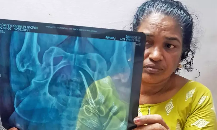 ഉഷ ജോസഫിന്‍റെ ശസ്ത്രക്രിയ പൂർത്തിയായി; പുറത്തെടുത്ത കത്രിക പൊലീസിന് കൈമാറി  | Usha Joseph's surgery completed; scissors recovered handed over to police  | Madhyamam