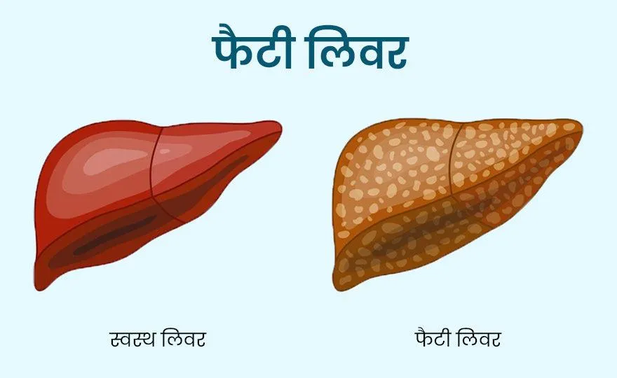 फैटी लीवर के घरेलू उपचार के साथ जानें उसके कारण और लक्षण – NAMHYA