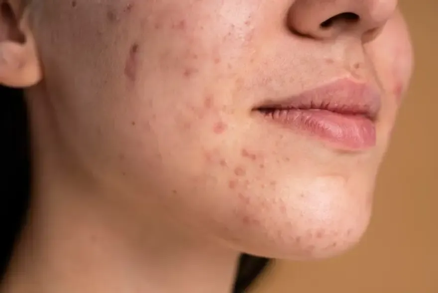 Acne in Hindi: मुंहासे (एक्ने) कारण, लक्षण, प्रकार और उपचार