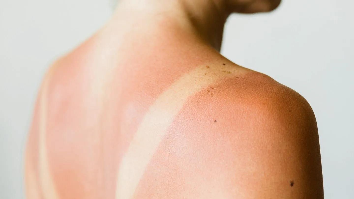 7 Quick At-Home Sunburn Treatments | Everyday Health