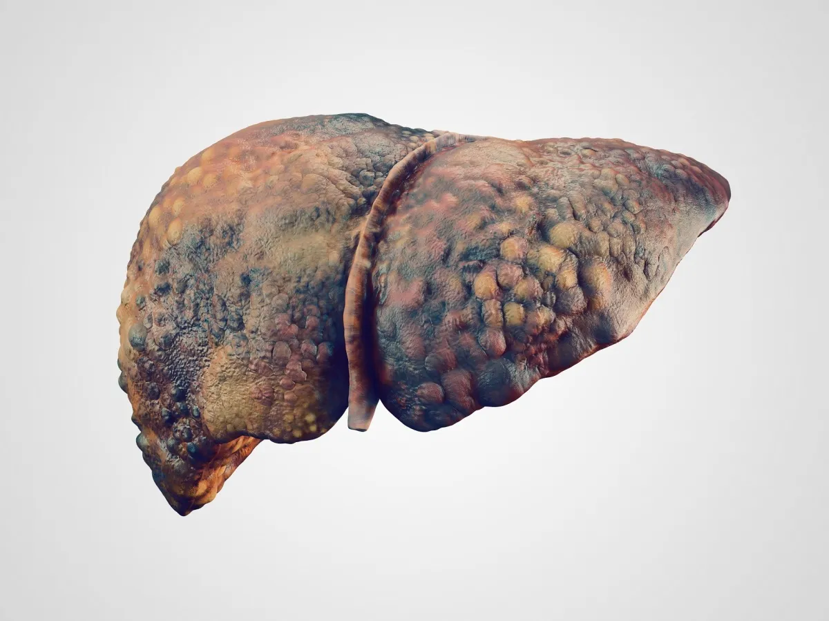 Why liver cancer screening rates must improve &bull; healthcare-in-europe.com