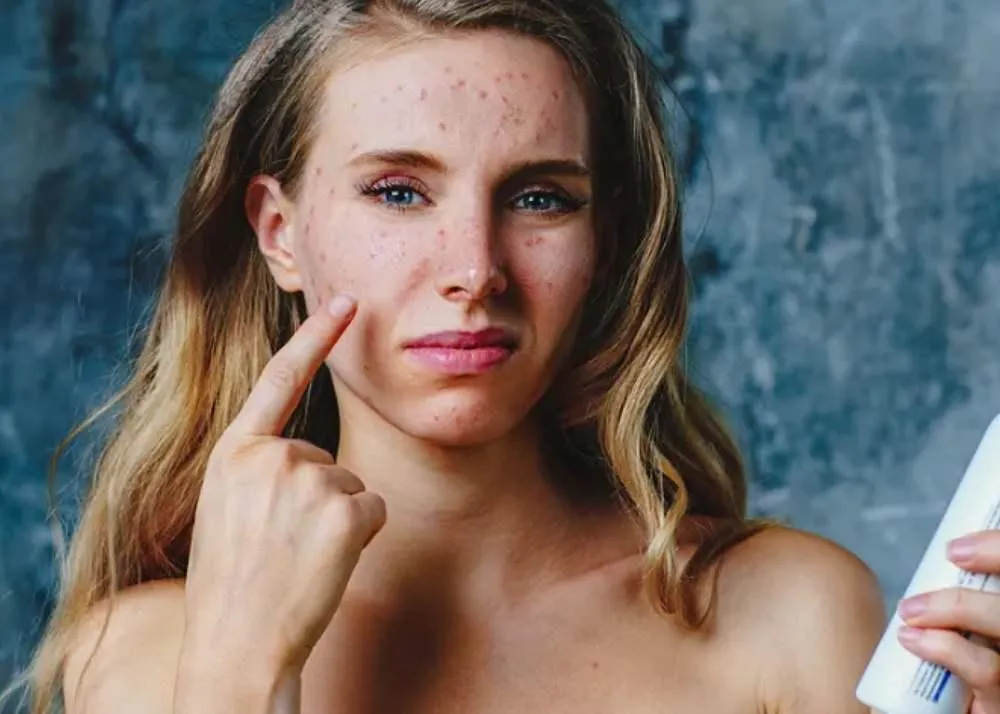 salcylic acid benefits 