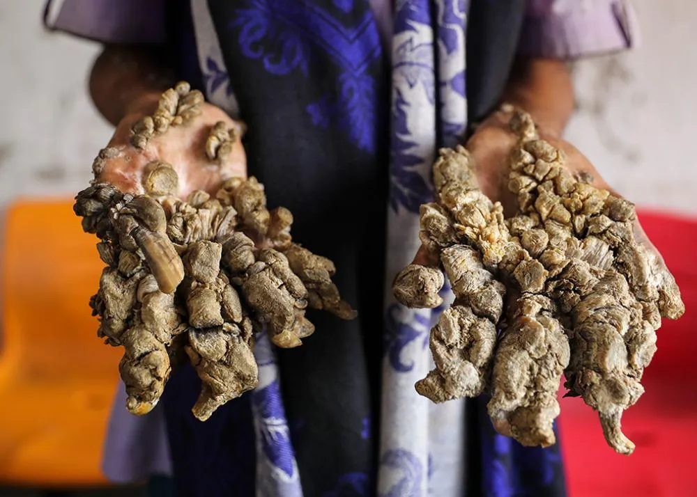 top 10 rare diseases