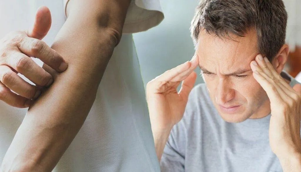 monkeypox virus symptoms