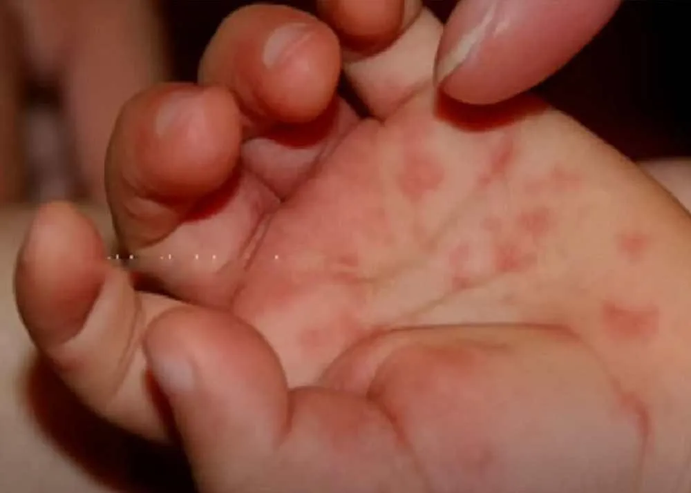 tomato fever symptoms