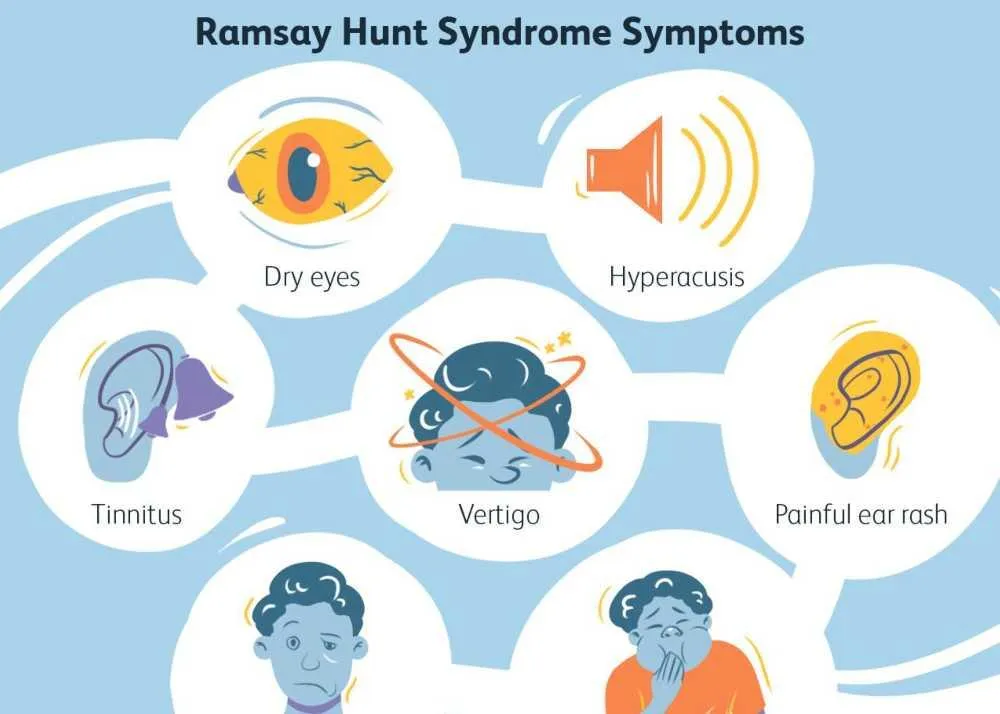 ramsay hunt syndrome symptoms