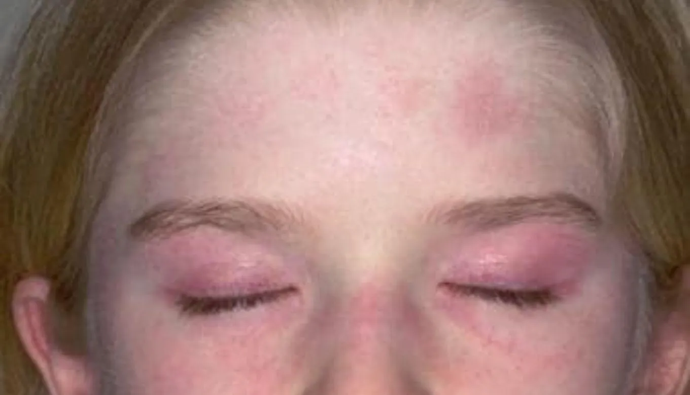 Dermatomyositis Causes, symptoms