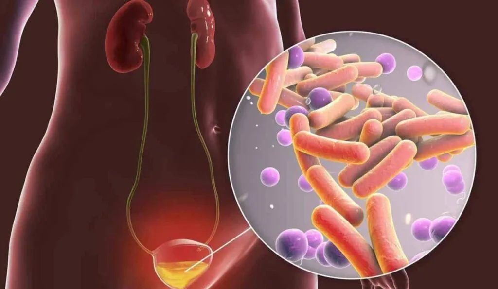 urinary tract infections