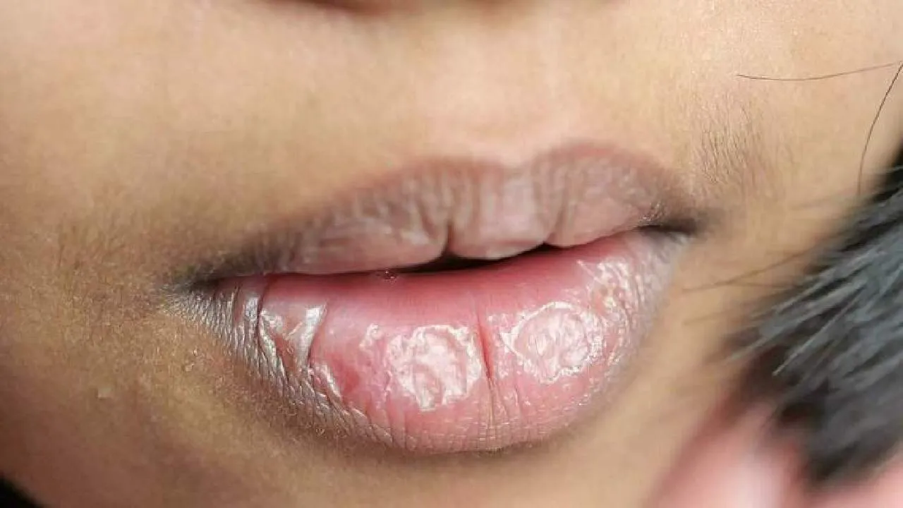 Dry Lips