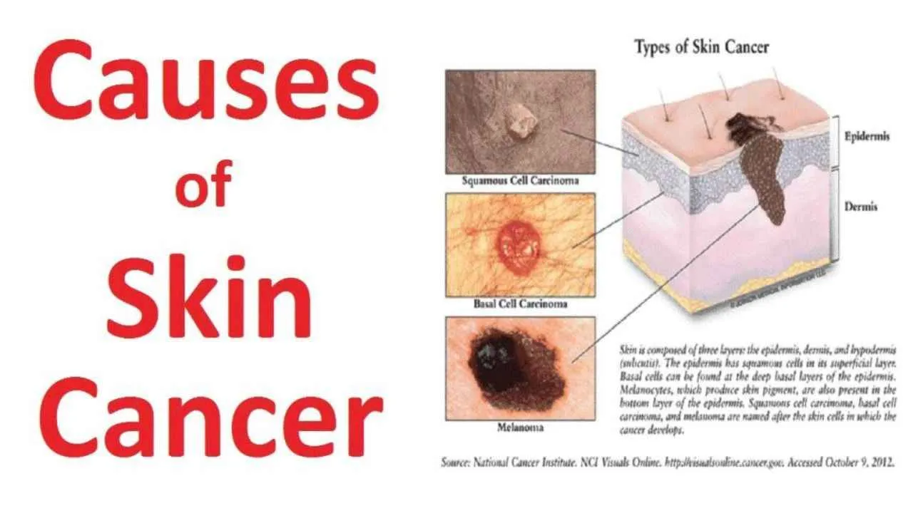 skin cancer