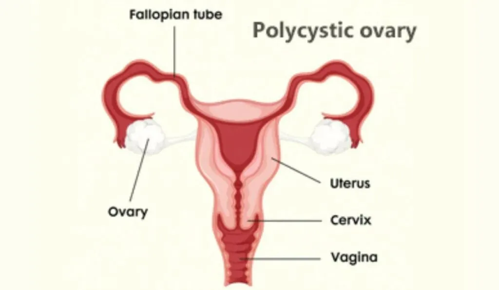 PCOD