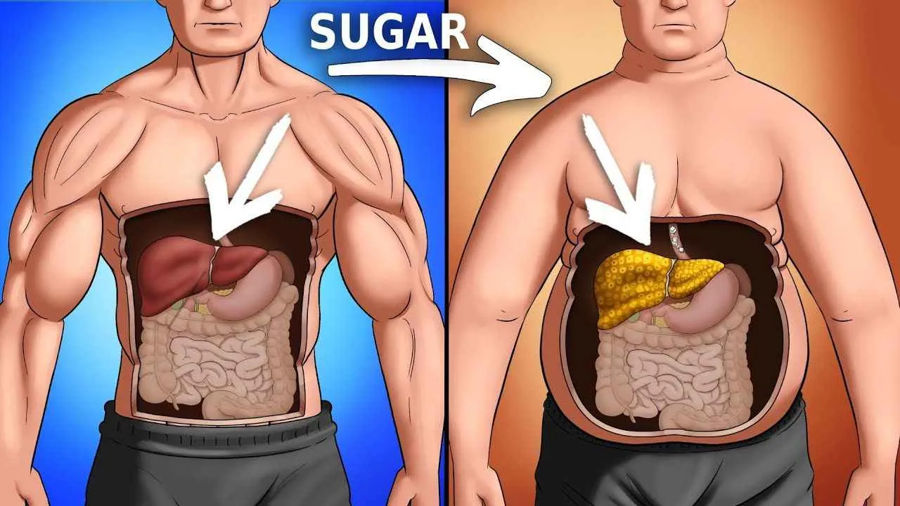 Sugar Cause Fatty Liver
