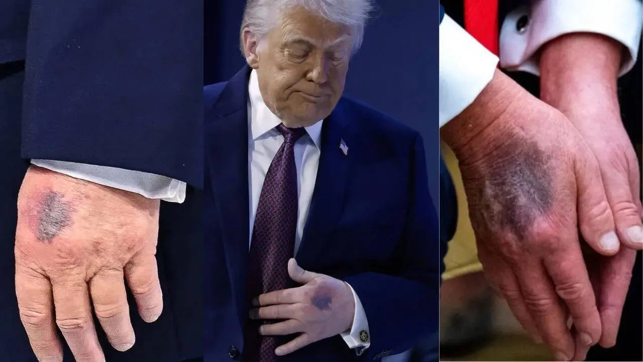 trump hand bruise aspirin health trump ko kaun si bimari hai: कौन सी बीमारी  से जूझ रहे ट्रंप? हाथ पर नीले निशान को लेकर राष्ट्रपति ने खुद बताया