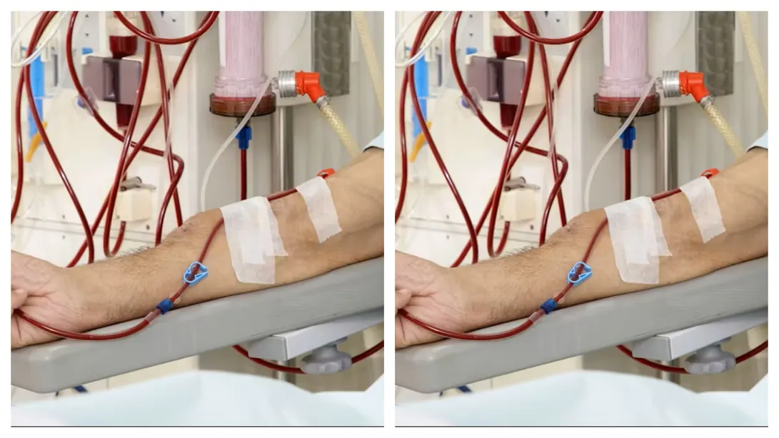 Dialysis