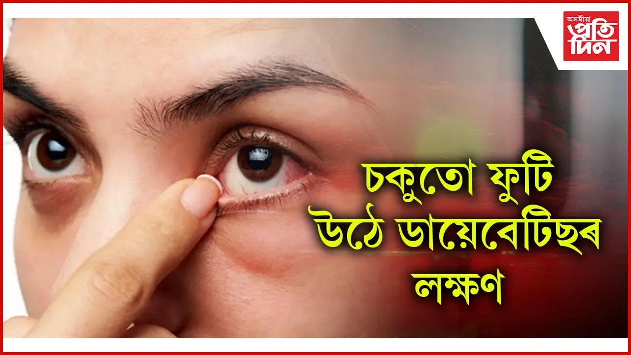 ডায়েবেটিছ