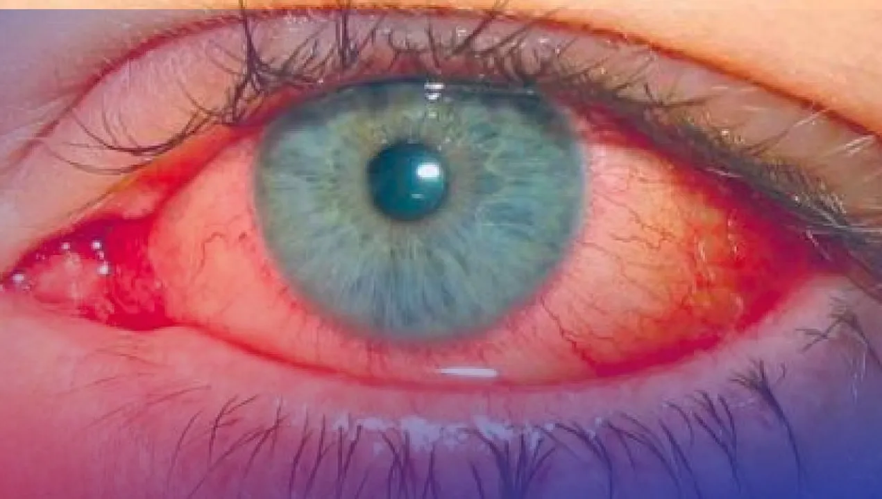 'জয়বাংলা' নে 'মাদ্ৰাজ আই'? জানো আহক এই ৰোগৰ কাৰণ-লক্ষণ-প্ৰতিকাৰৰ উপায়