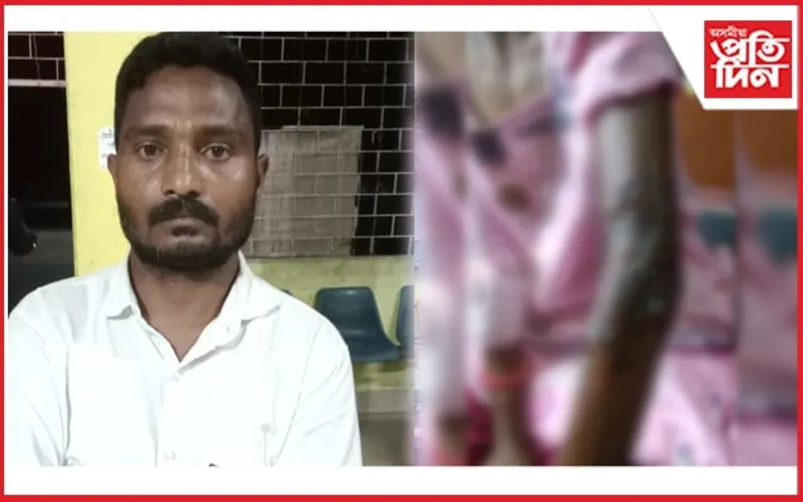 কাকপথাৰত বনকৰা কিশোৰীৰ শৰীৰত গৰমপানী ঢালি নিৰ্যাতন ছাত্ৰ নেতাৰ...