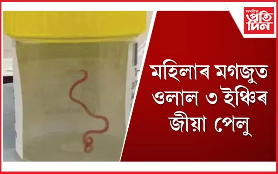 এয়া বিশ্বৰ প্ৰথম ঘটনা, অজগৰৰ গাত হোৱা পেলু হ'ল মানুহৰ মগজুত