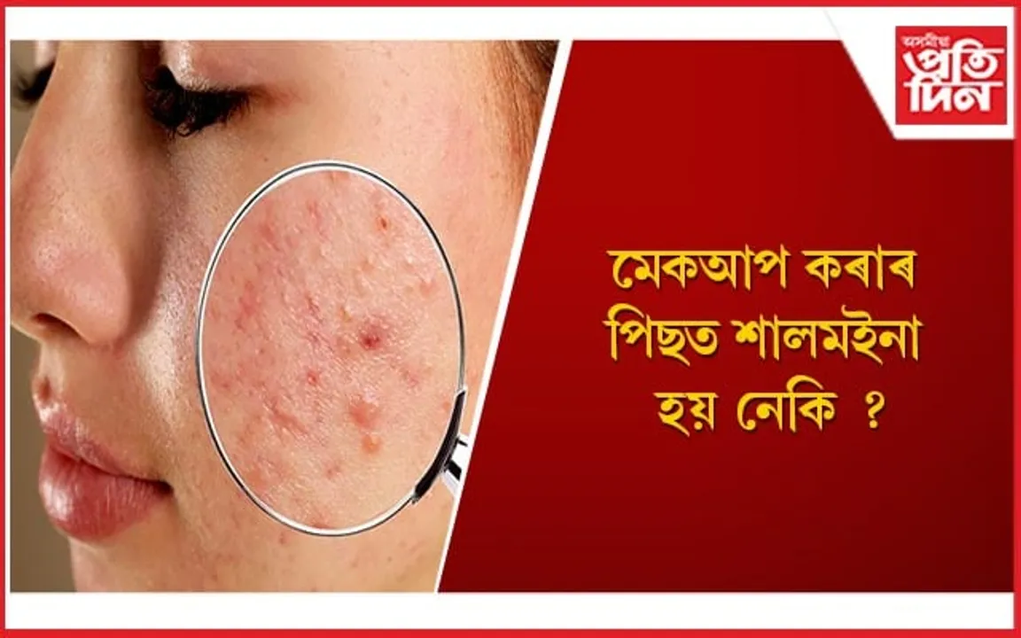 এই ঘৰুৱা উপায়ৰে দূৰ কৰক শালমইনাৰ সমস্যা