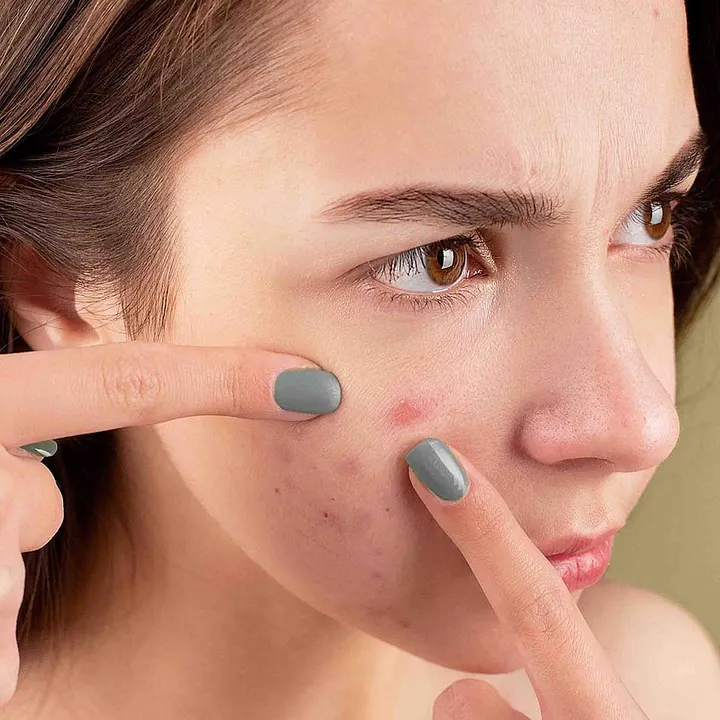  Hereâ€™s how adult acne differs from hormonal acne