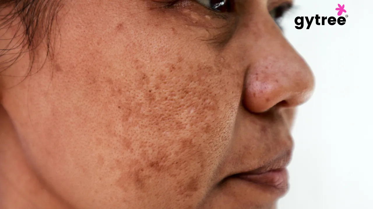 Why am I having black spots on my face ?