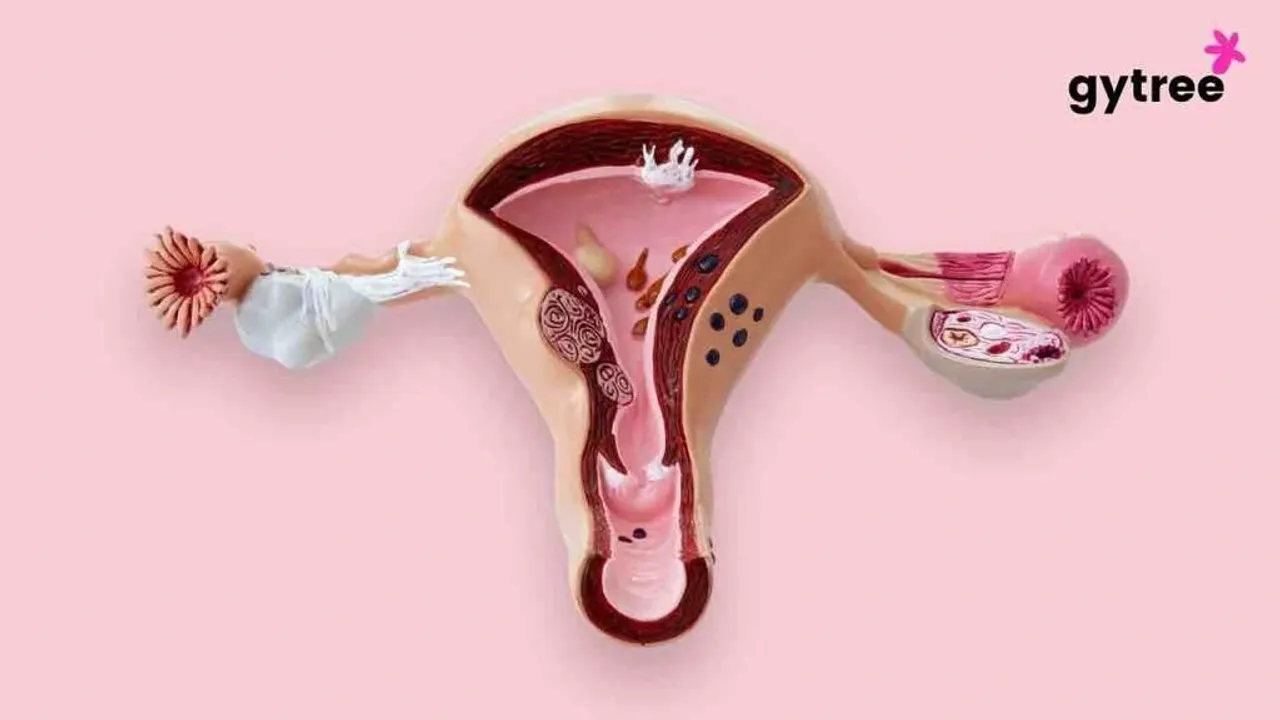 “The Complete Guide to unravel the intricate web of the symptoms causes and treatment of Polycystic Ovary Syndrome"