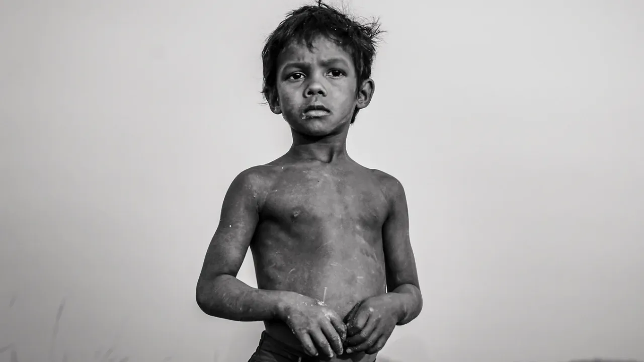 Malnutrition कुपोषण 