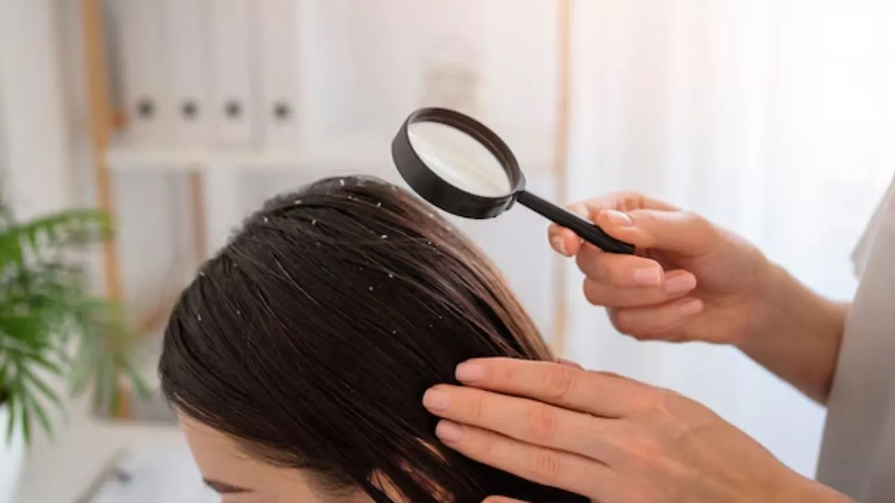 dandruff