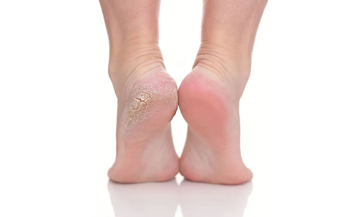 5 best solutions to soften your cracked heels