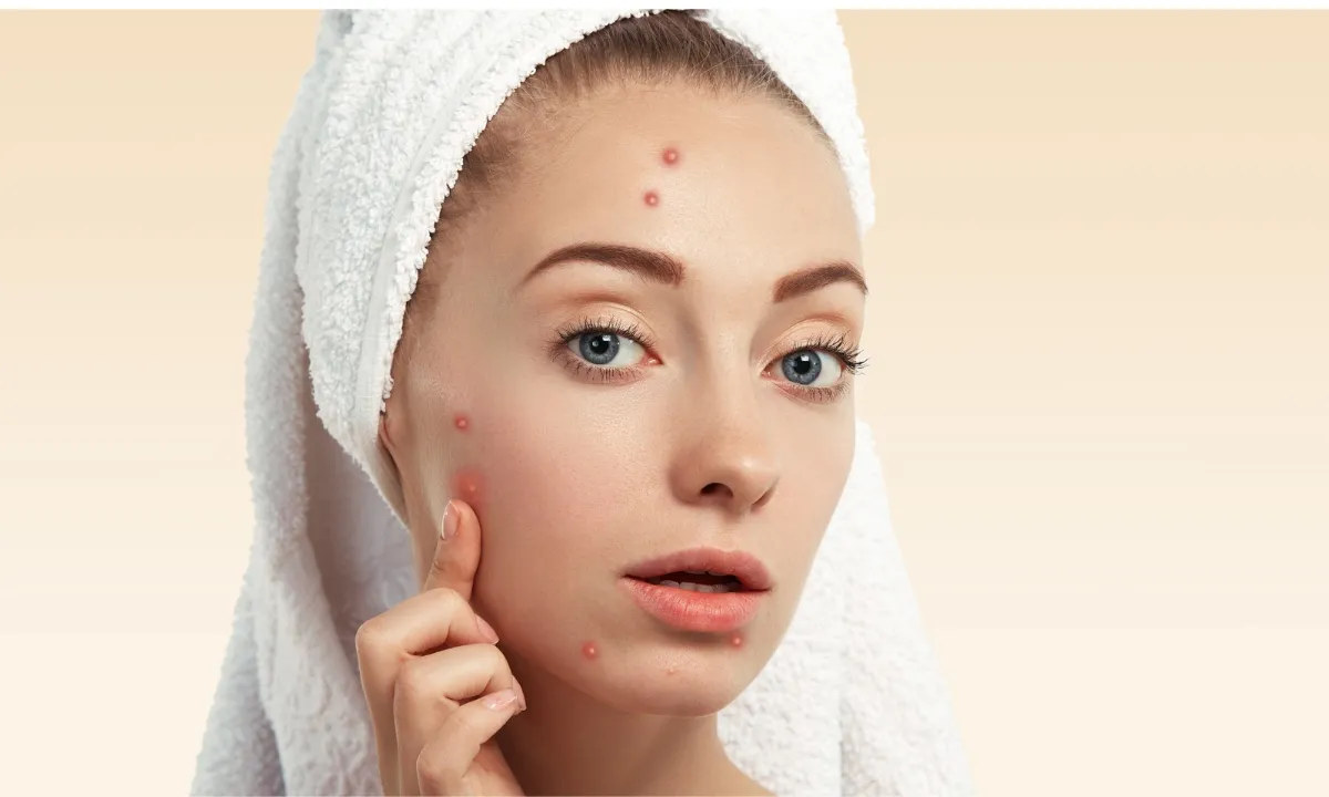 Pimple