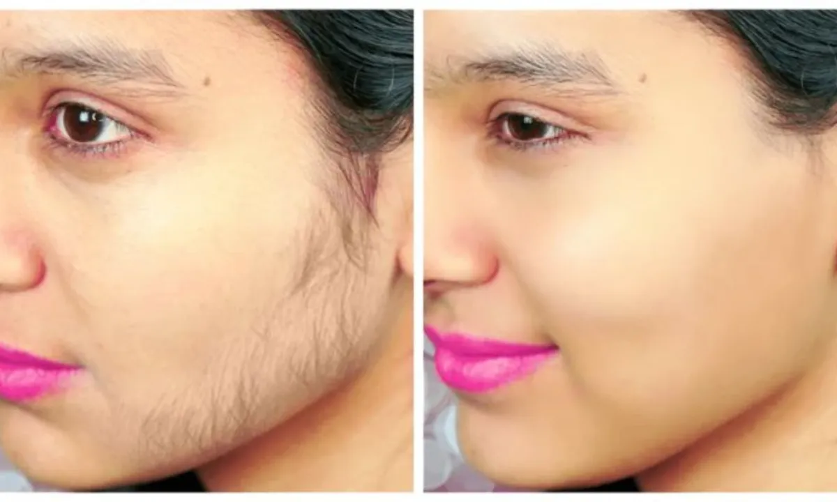 Follow These 5 Easy Methods To Remove Unwanted Hair From Face