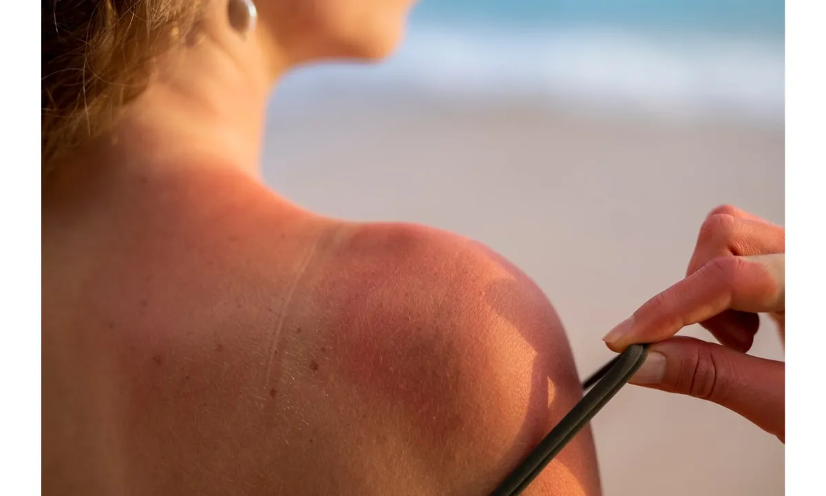 Tanning Before Marriage Ruins Your Skin? Try These Simple Remedies