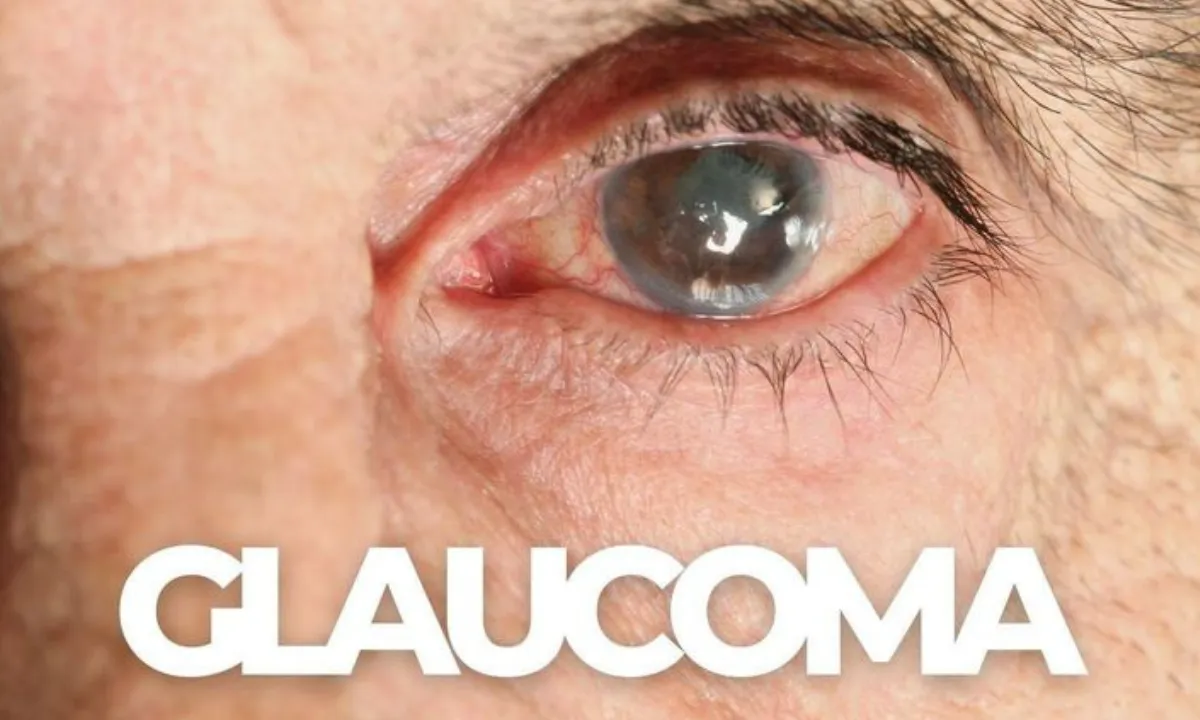 glaucoma