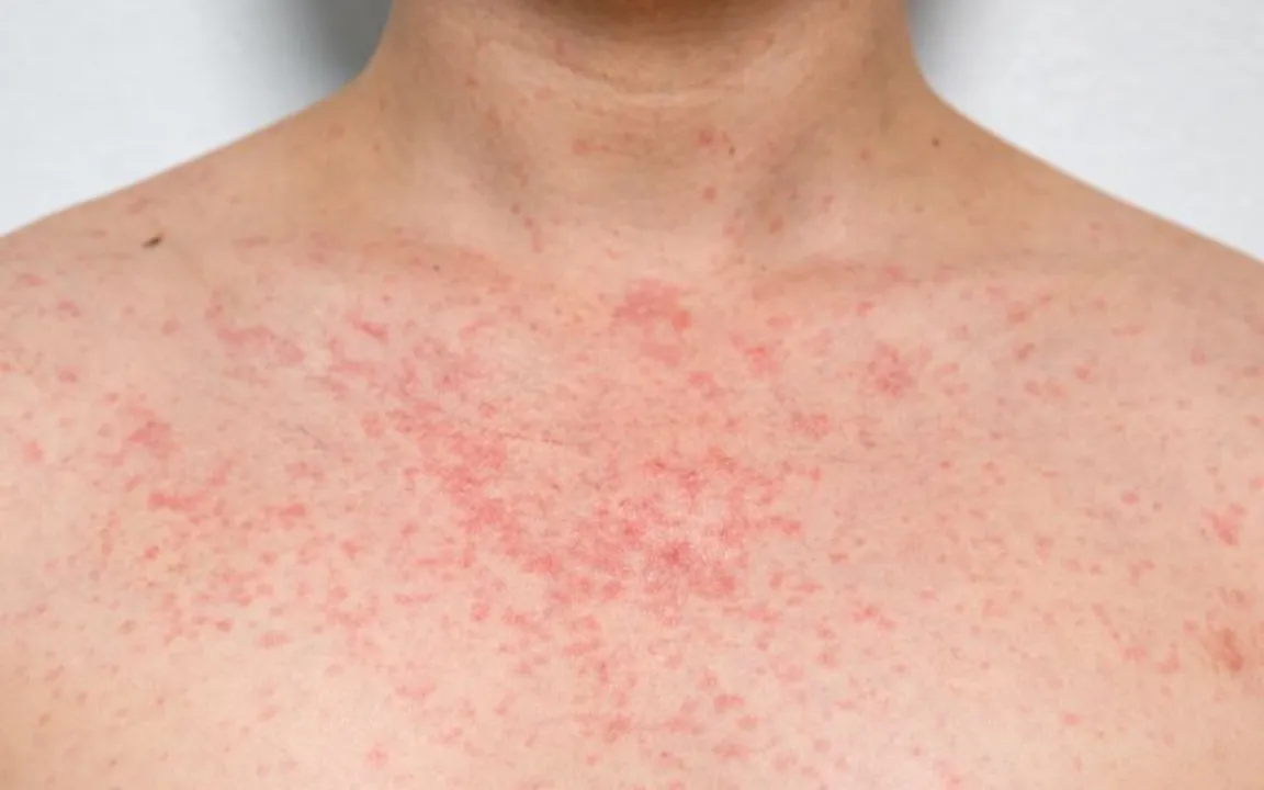 HEAT RASH