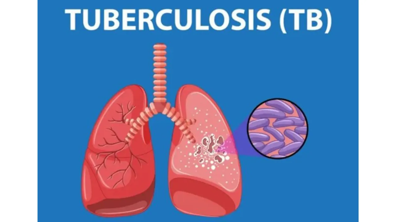 These Are The 5 Symptoms Of Having TB, Let's Find Out