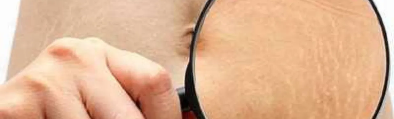Stretch Marks 0. png