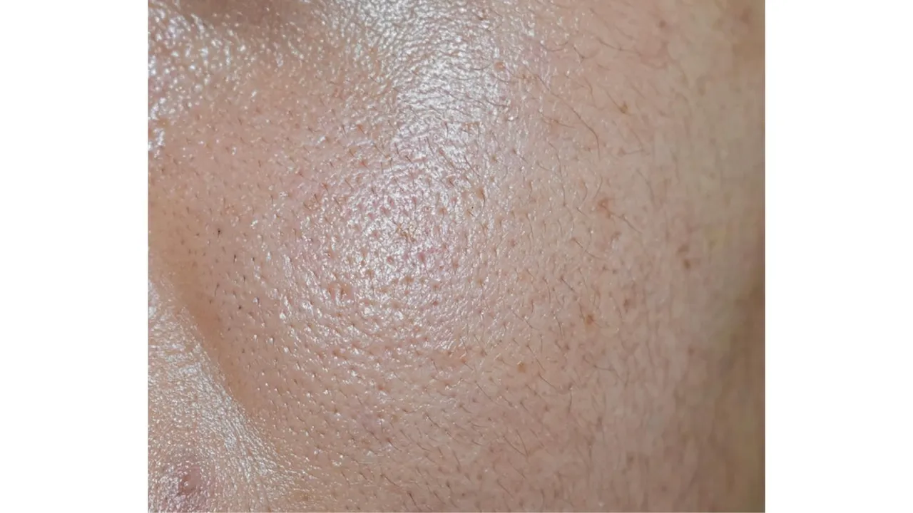 Oily face (Lifehacker).png