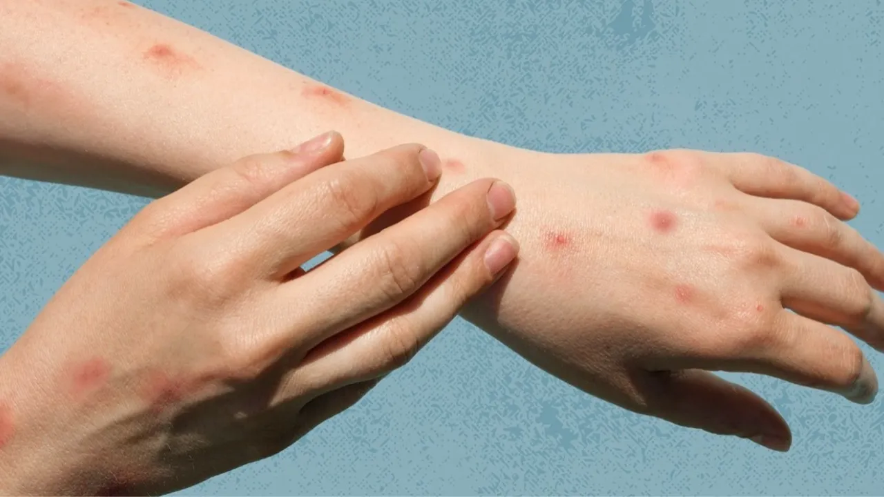 MPox