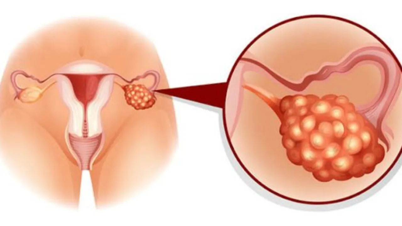 Ovarian Cyst (Pinterest).png