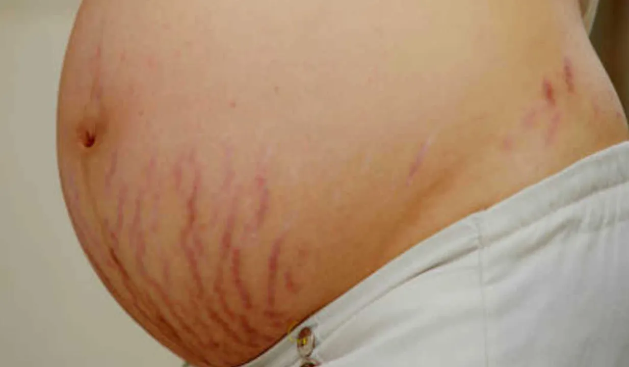 Stretch Marks (NBT)