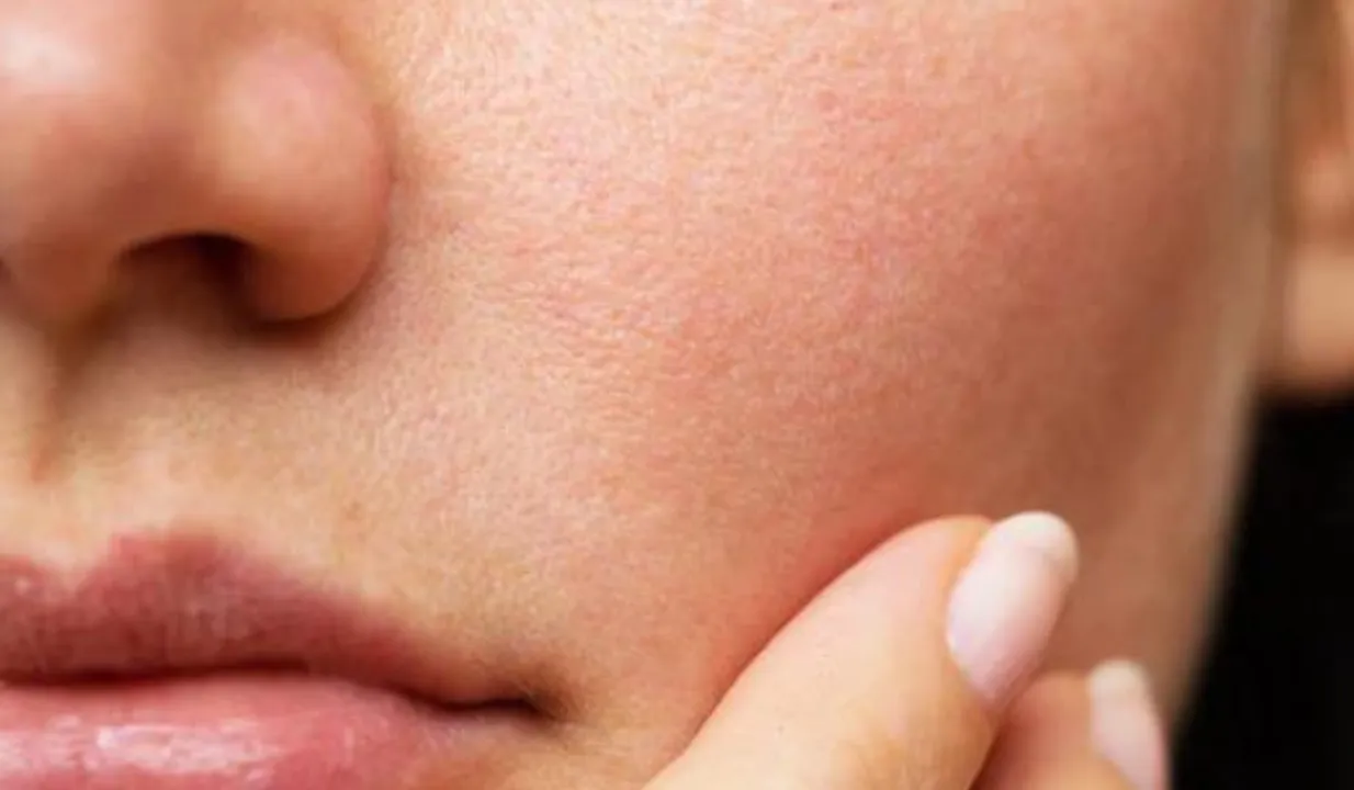 Open Pores(SkinCraft)