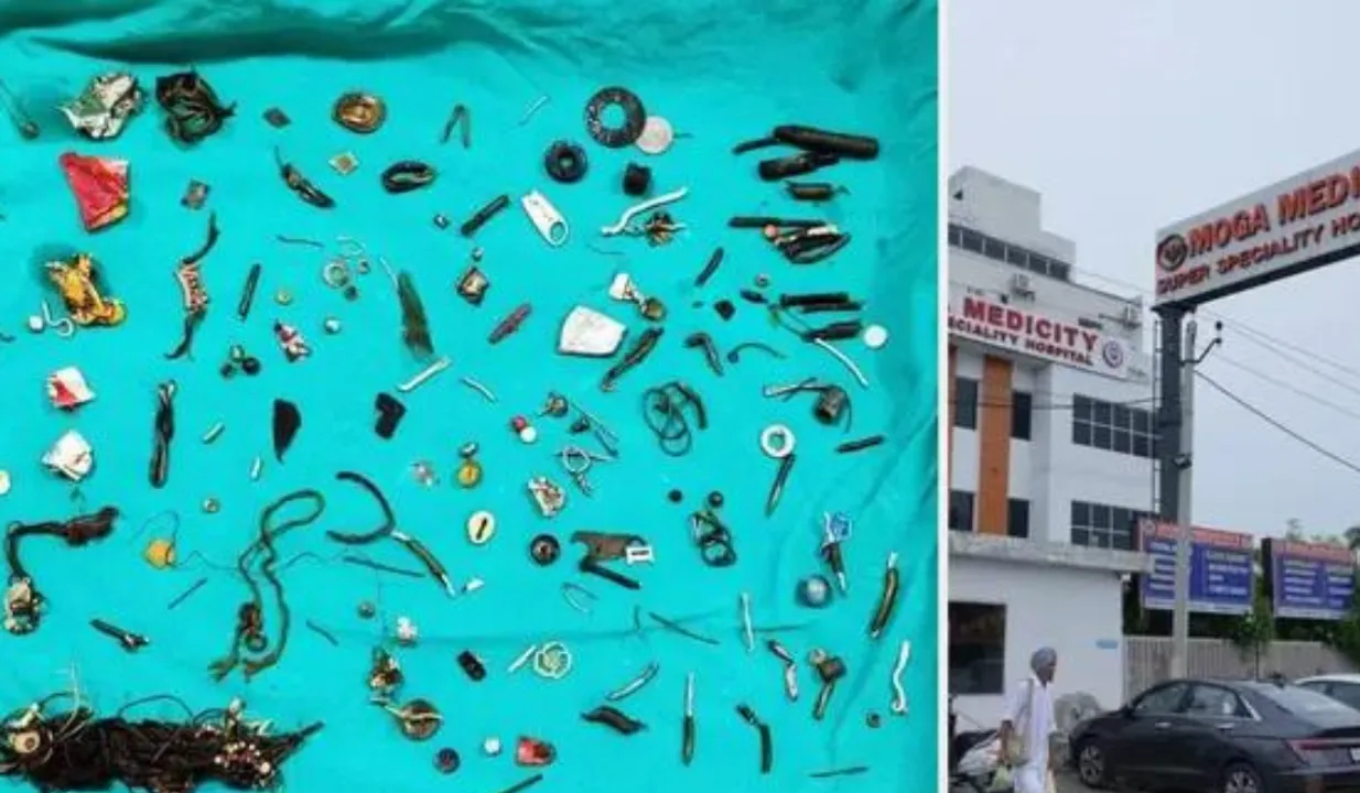 Over 60 Objects Removed From Man Stomach