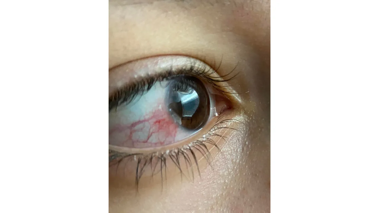 Red eye (Reddit).png