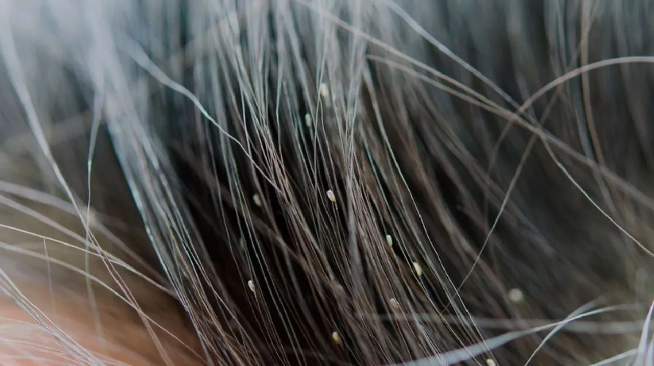 Hair Lice Remedies 