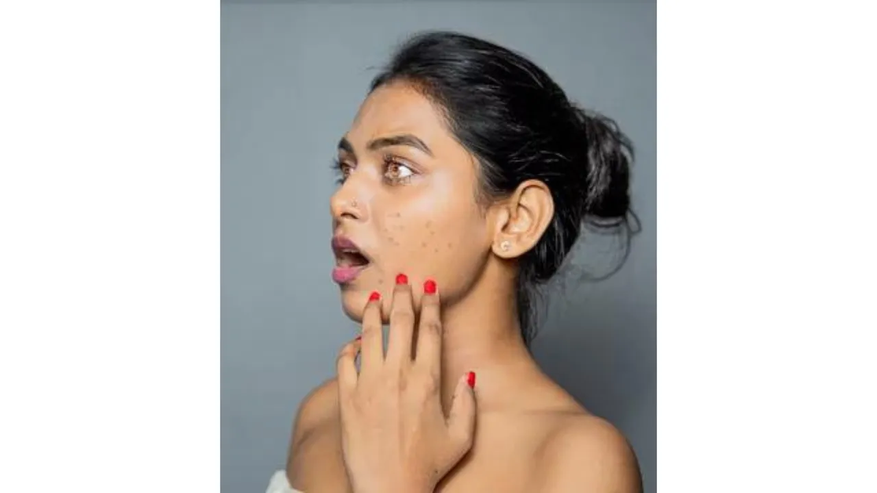 Acnes (Adobe Stock).png