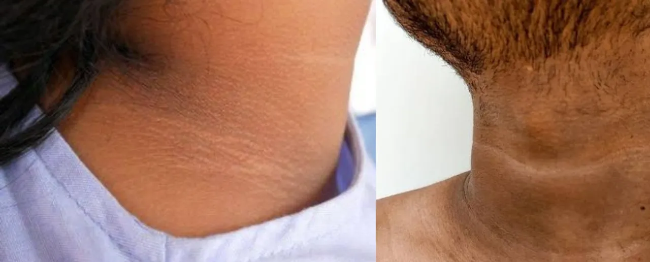 Home Remedies For Dark Neck.png
