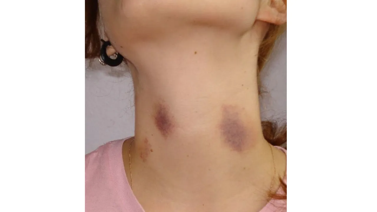 Love Bite (Wikipedia).png