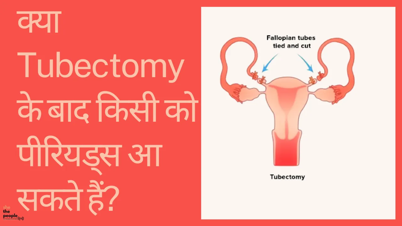Tubectomy