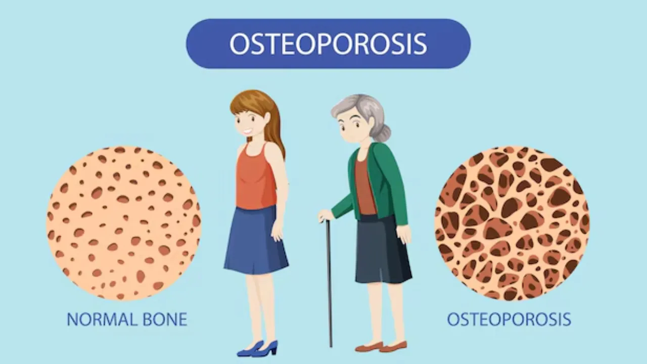 Osteoporosis