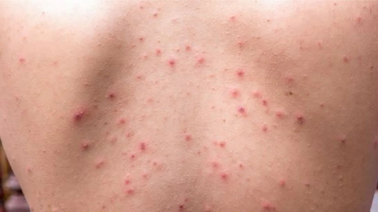 How To Reduce Back Acne